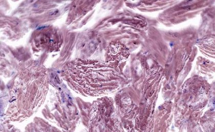Image of pink-coloured cancer cells